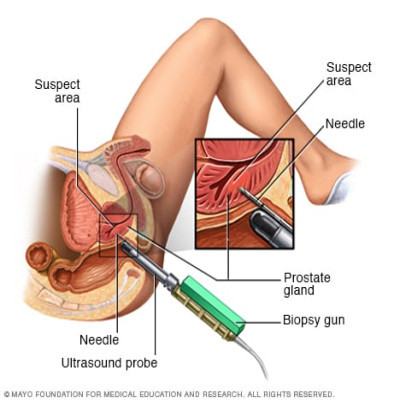 Biopsia Prostatica transrectal bajo sedacion