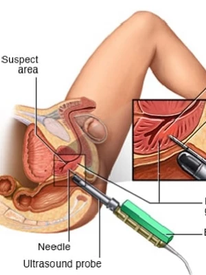 Biopsia de próstata bajo sedacion